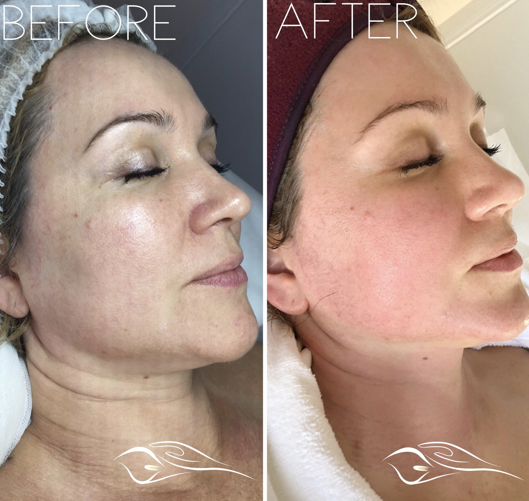 Radiofrequency facial online